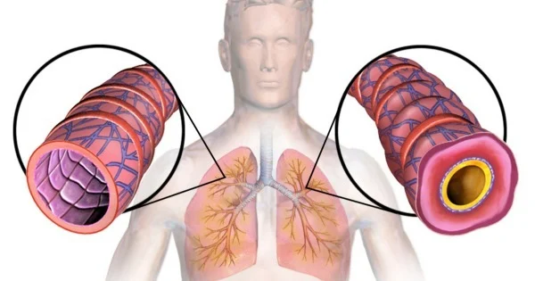Bronquite Crônica: O Que É, Para Que Serve o Diagnóstico, Causas, Sintomas, Tratamentos, Complicações e Como Prevenir