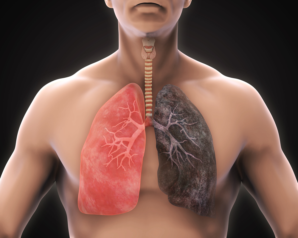 Enfisema Pulmonar: O Que É, Para Que Serve o Diagnóstico, Sintomas, Causas, Tratamento, Complicações e Prevenção