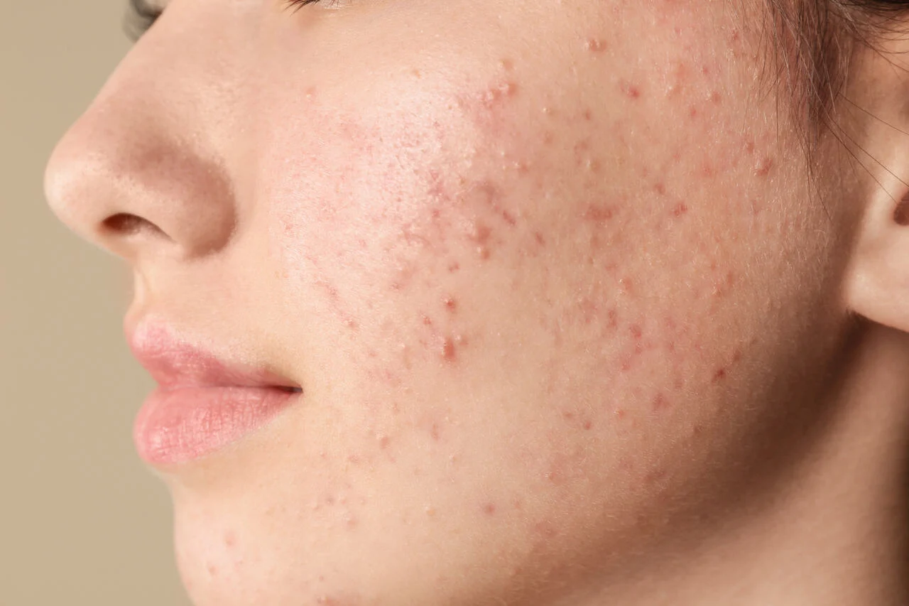 Acne: O Que É, Para Que Serve o Tratamento, Efeitos Colaterais, Como Controlar e Alternativas