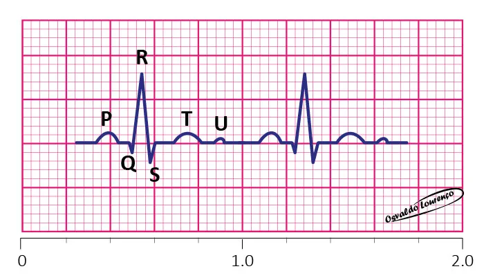 Eletrocardiograma (ECG): O Que o Coração Revela no Gráfico