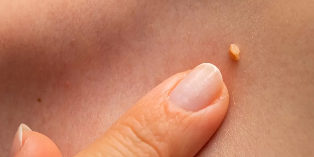 HPV: O Que É, Como Se Transmite, Sintomas, Tratamento e Prevenção