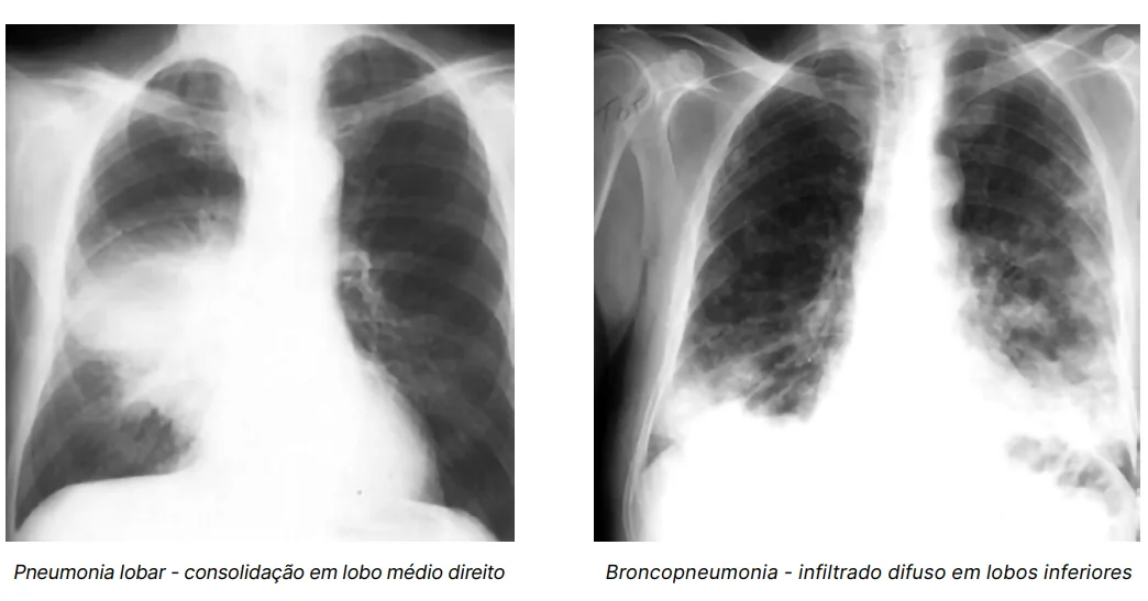 Pneumonia: O Que É, Sintomas, Causas, Tratamento e Como Prevenir
