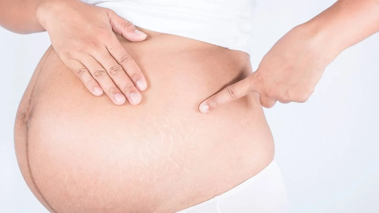 Estrias na Gravidez: Como Prevenir e Tratar Após o Parto